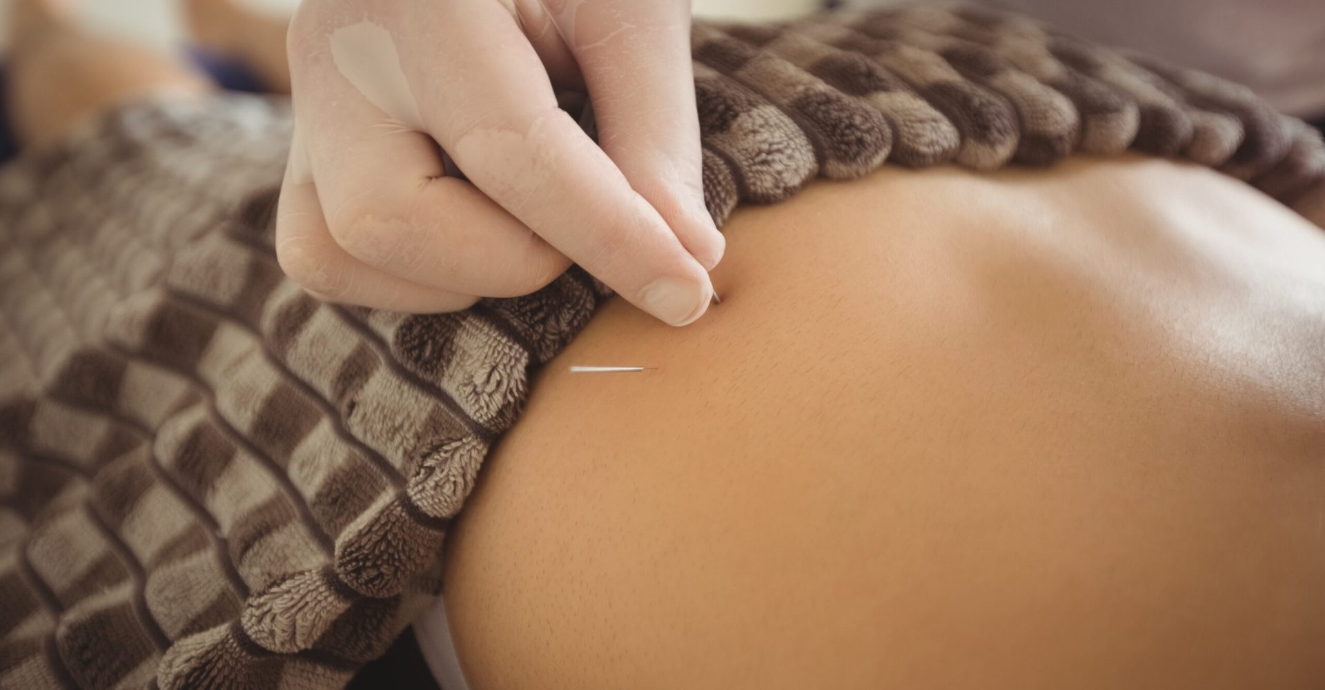 Close-up of physiotherapist inserting needle for dry needling on patient